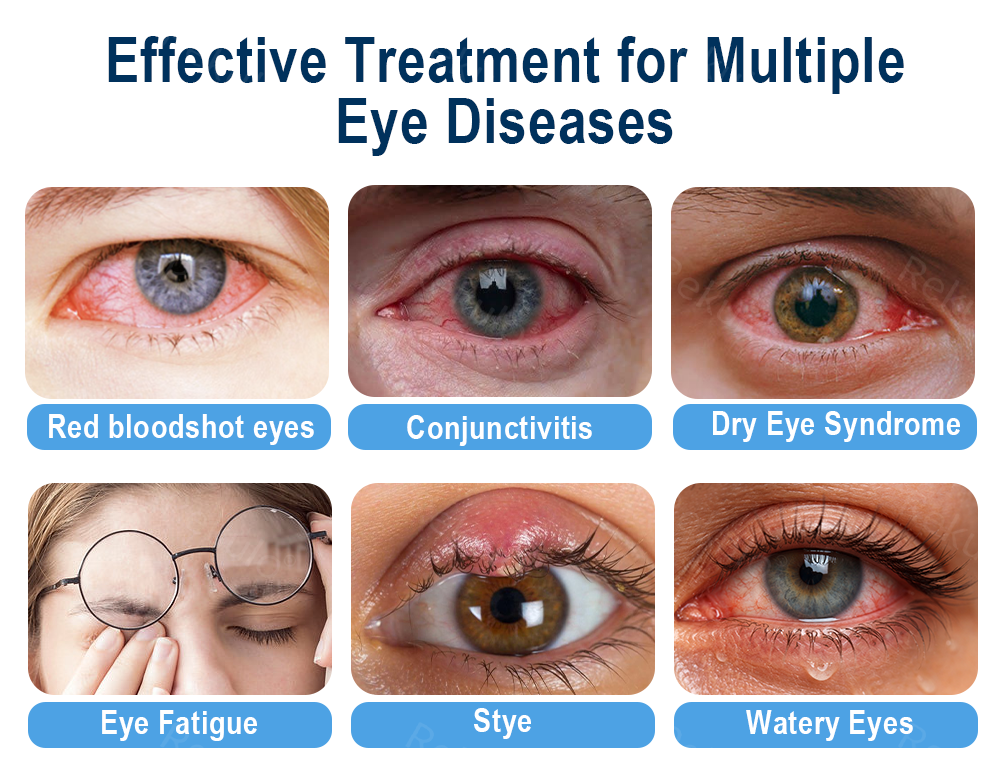 Rekulo® OptiMist Eye Spray✅For dry eyes, blurry vision, eye strain, presbyopia, and cataracts ✨