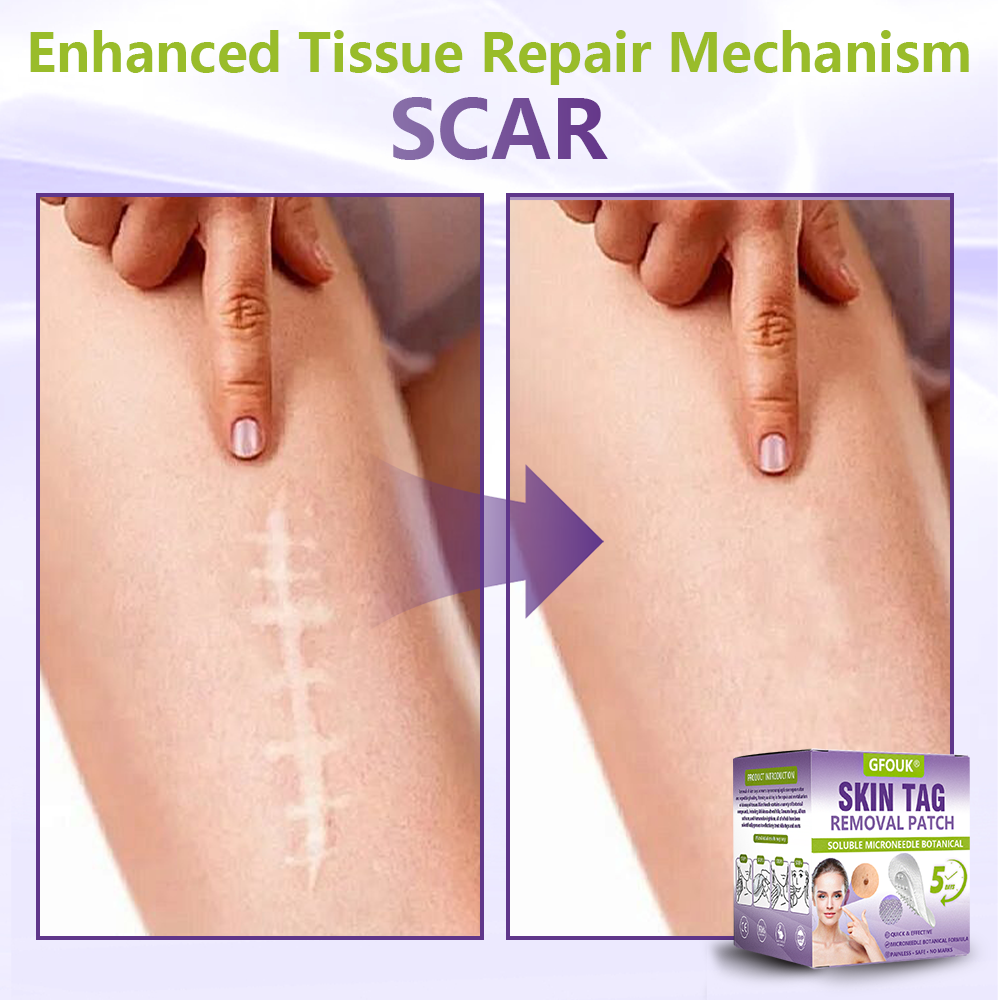 GFOUK® Soluble Microneedle Botanical Skin Tag Removal Patch up