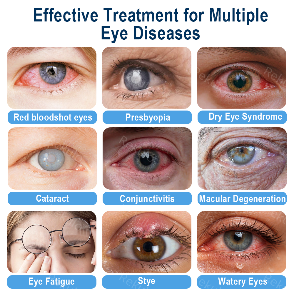 Rekulo® OptiMist Eye Spray✅For dry eyes, blurry vision, eye strain, presbyopia, and cataracts 👀👀