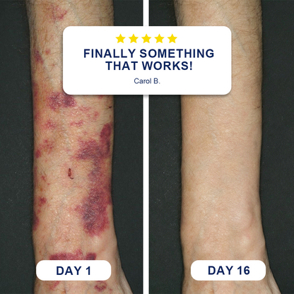 💥120K+ SOLD💕- Evolvion® Bruise Repair & Skin-Strengthening Cream🍀