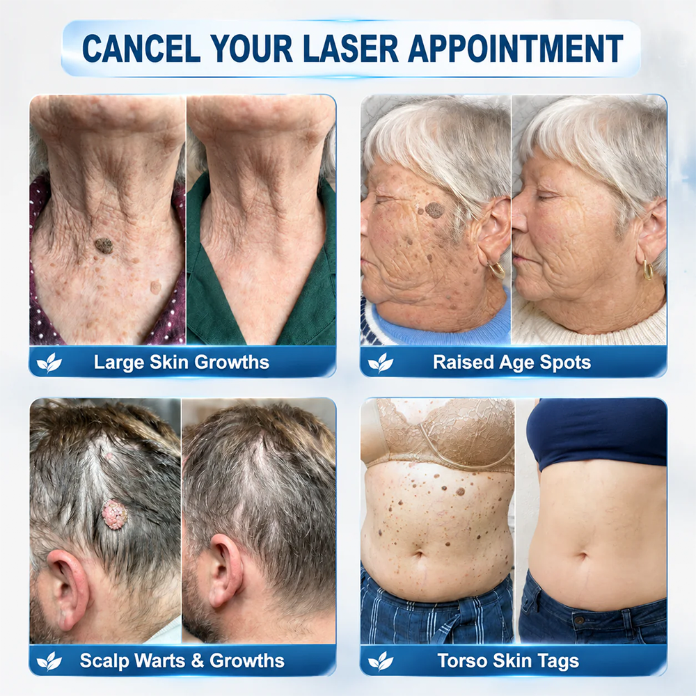 ✨Evolvion® 𝟕-𝐃𝒂𝘆 𝐒𝗸𝐢𝐧 𝐓𝒂𝗴 & 𝐒𝐩𝙤𝐭 𝐄𝐫𝒂𝐬𝙚𝐫 Painless & Scar-Free Advanced Imperfection Remova𝗜 Ro𝗜𝗜erba𝗜𝗜 Pen