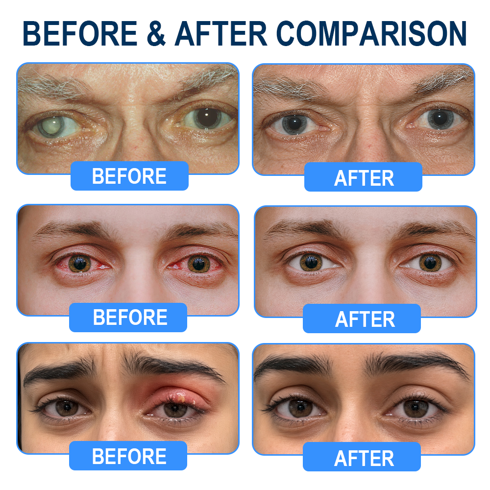 Rekulo® OptiMist Eye Spray✅For dry eyes, blurry vision, presbyopia, and cataracts 👀