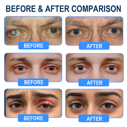 Rekulo® OptiMist Eye Spray✅For dry eyes, blurry vision, presbyopia, and cataracts 👀