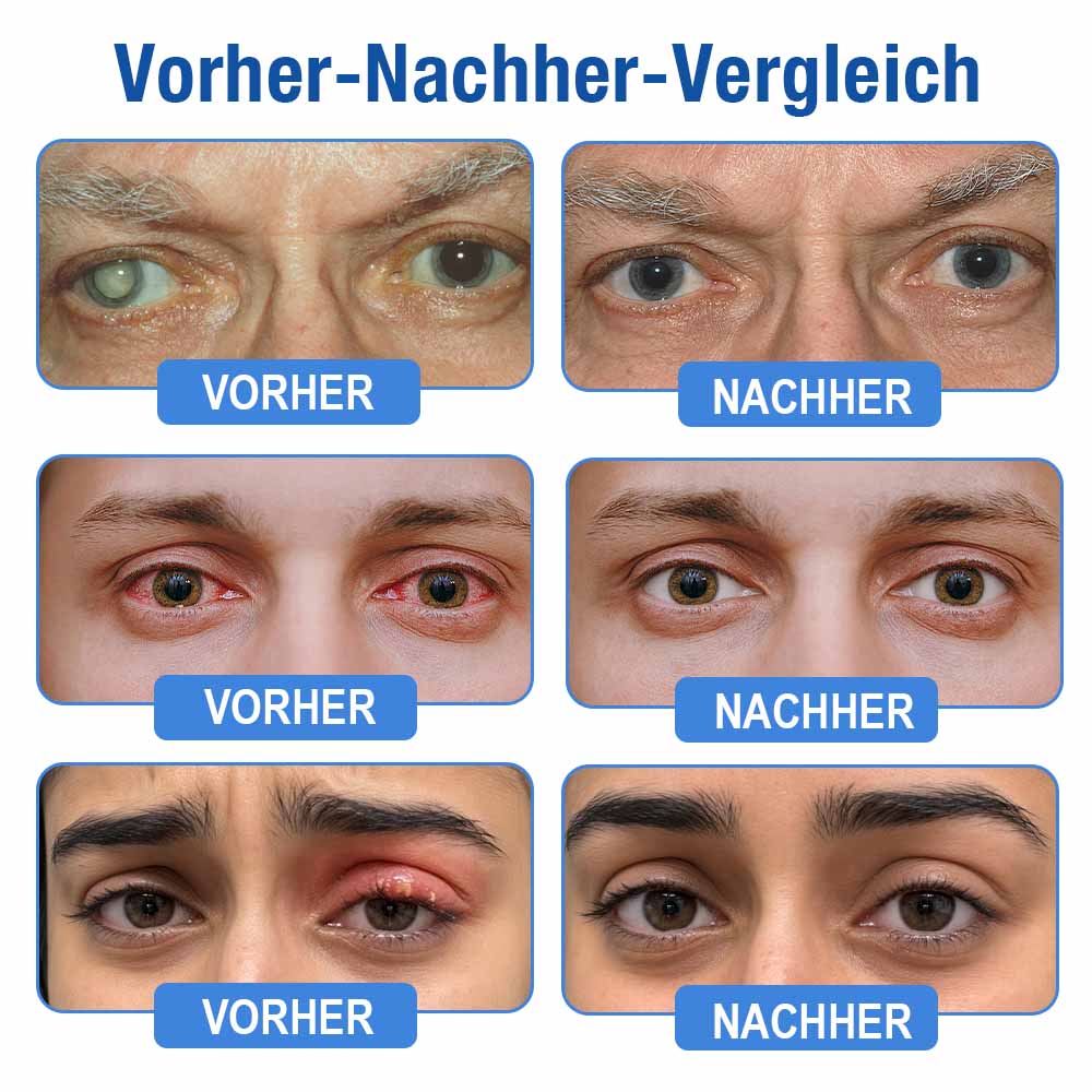 👨‍⚕️ DR.Fachmer® LensClarity Eye Drops✅For dry eyes, blurry vision & presbyopia