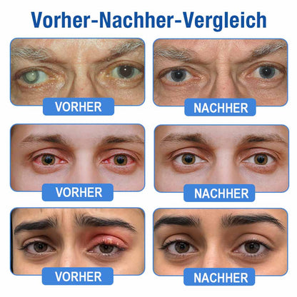👨‍⚕️ DR.Fachmer® LensClarity Eye Drops✅For dry eyes, blurry vision & presbyopia