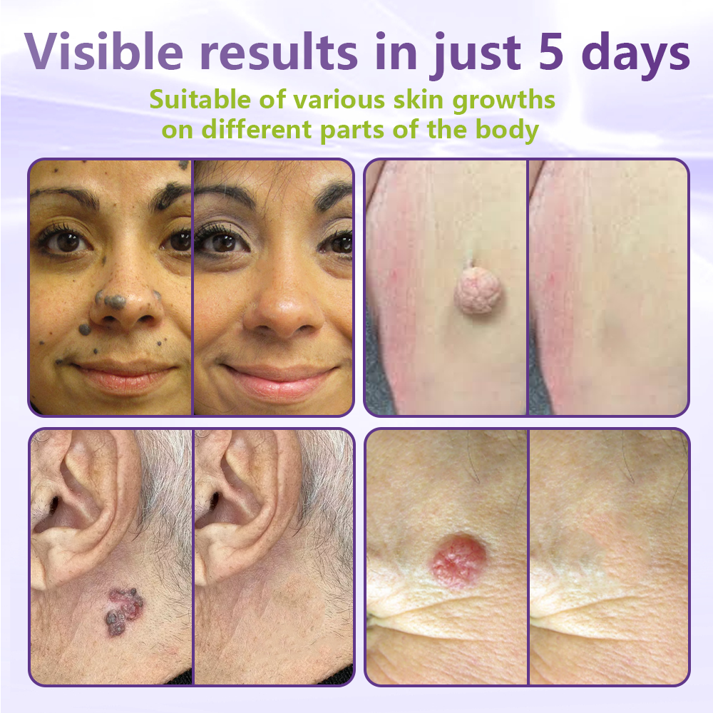 GFOUK® Soluble Microneedle Botanical Skin Tag Removal Patch up