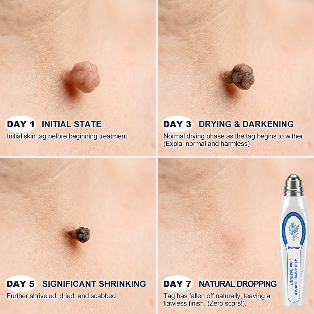 ✨Evolvion® 𝟕-𝐃𝒂𝘆 𝐒𝗸𝐢𝐧 𝐓𝒂𝗴 & 𝐒𝐩𝙤𝐭 𝐄𝐫𝒂𝐬𝙚𝐫 Painless & Scar-Free Advanced Imperfection Remova𝗜 Ro𝗜𝗜erba𝗜𝗜 Pen
