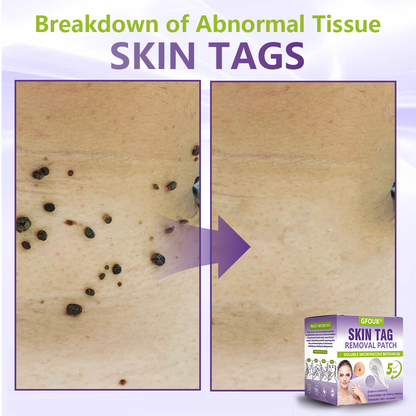 GFOUK® Soluble Microneedle Botanical Skin Tag Removal Patch up