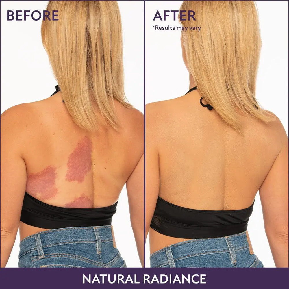 Rolimey® Body Coverage Perfector ✨Suitable for covering scars, spots, veins, tattoos, and other imperfections