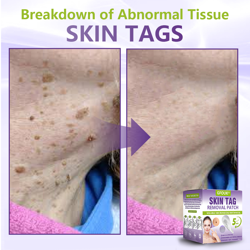GFOUK® Soluble Microneedle Botanical Skin Tag Removal Patch up