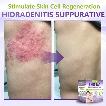 GFOUK® Soluble Microneedle Botanical Skin Tag Removal Patch up